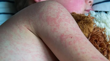 Sarampión: Argentina adelanta a los 18 meses la segunda dosis de la vacuna