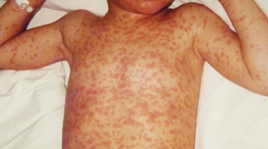 Sarampión: detectan dos casos más en el AMBA